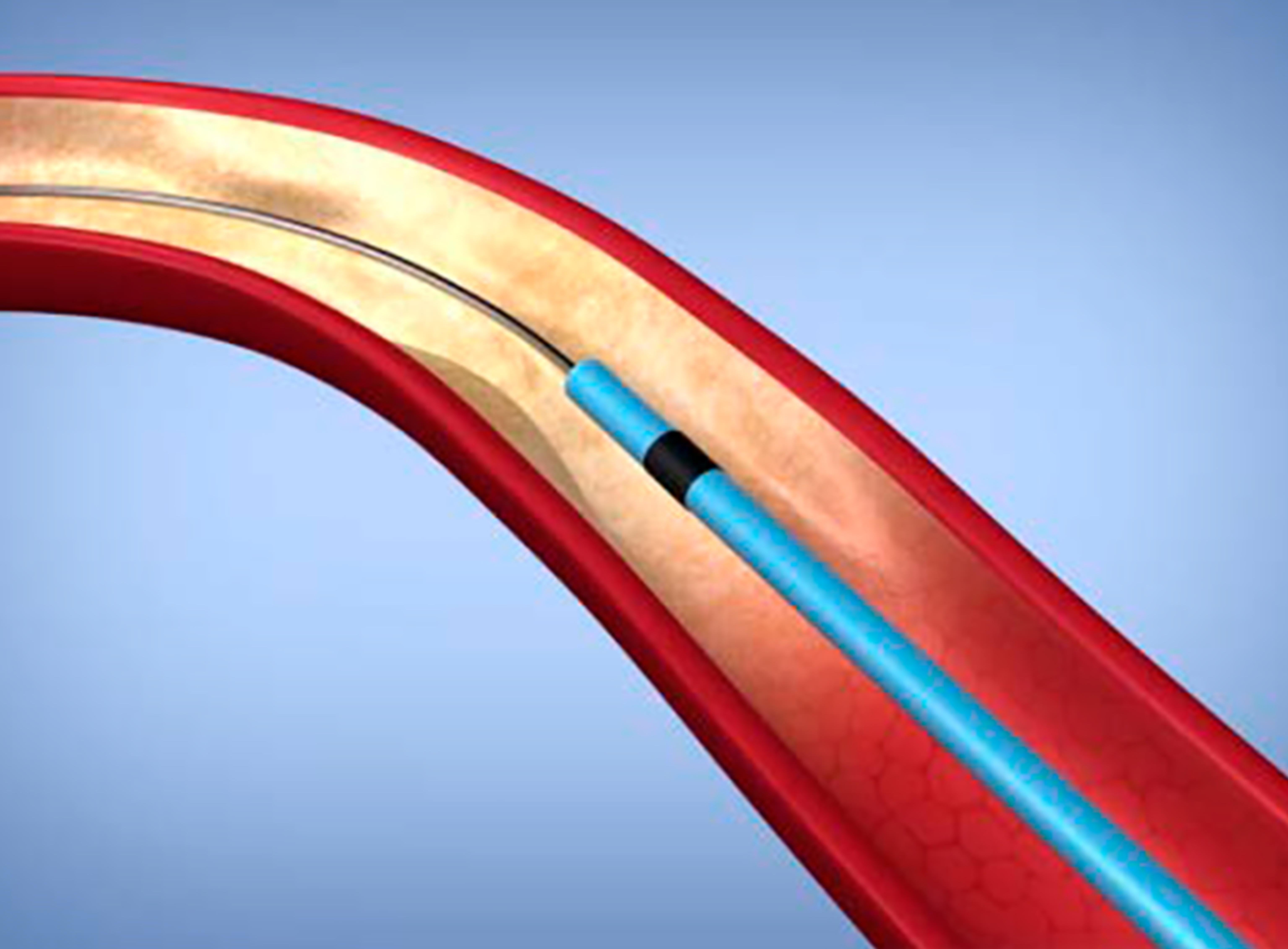 Engineered Metal Coating